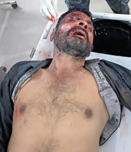 Read more about the article झारखंड स्वर्ण जयंती एक्सप्रेस से गिरकर युवक घायल